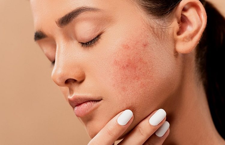 Rosacea