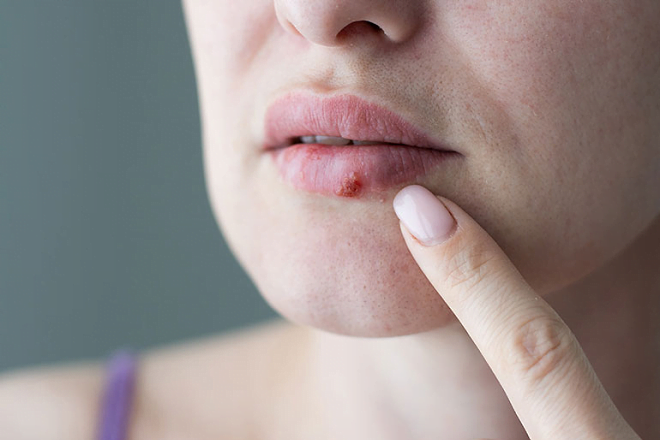 why-do-i-keep-getting-cold-sores-causes-treatments-the-run-time