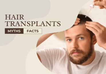 Hair Transplants Myths and Facts